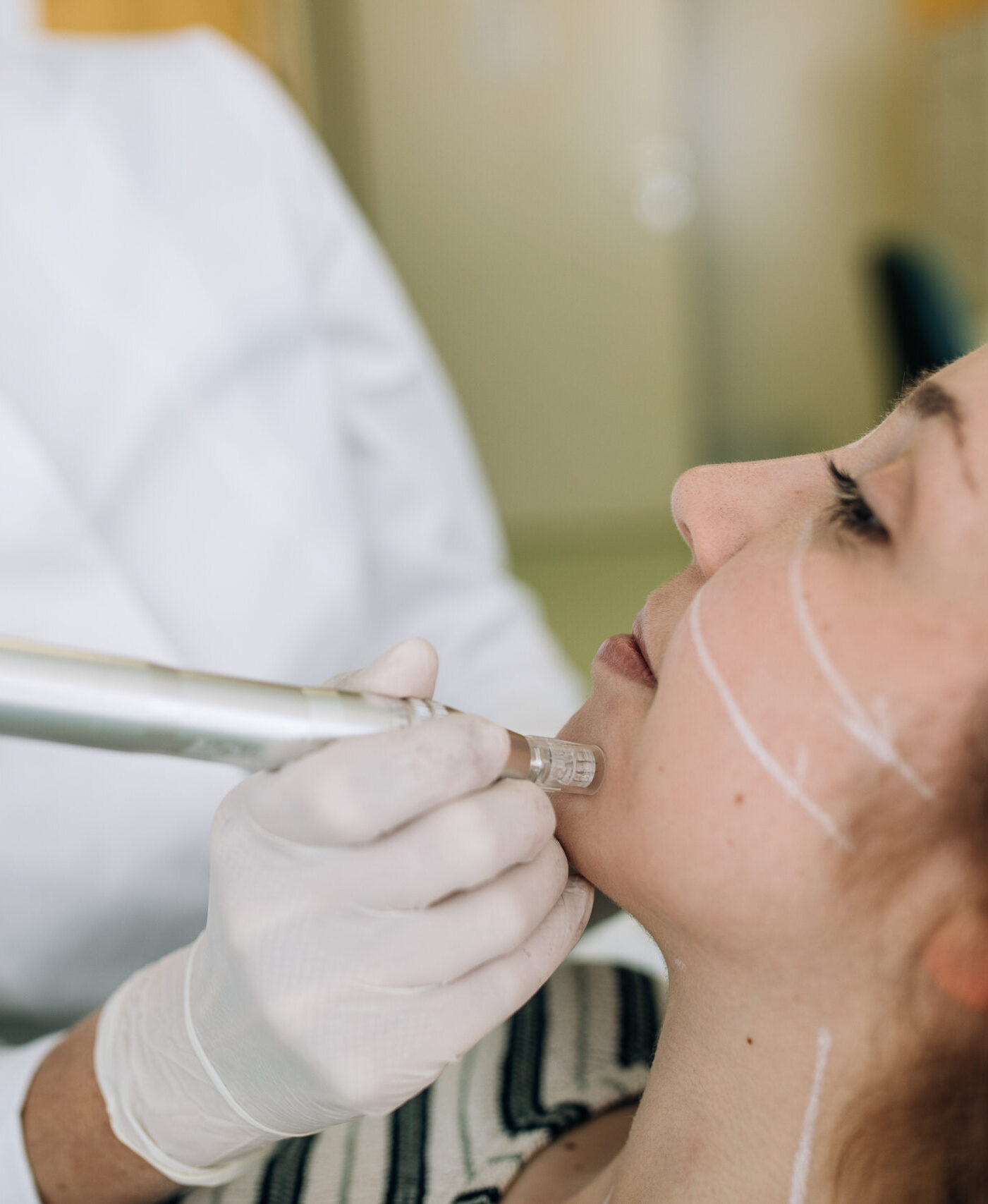 lepotna medicina lukan - microneedling