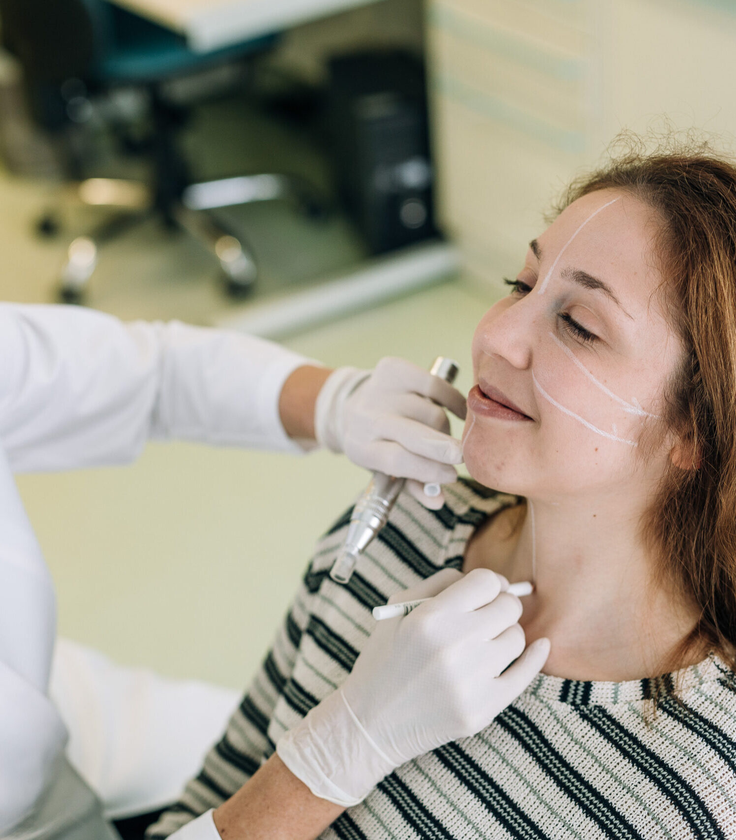 lepotna medicina lukan - microneedling