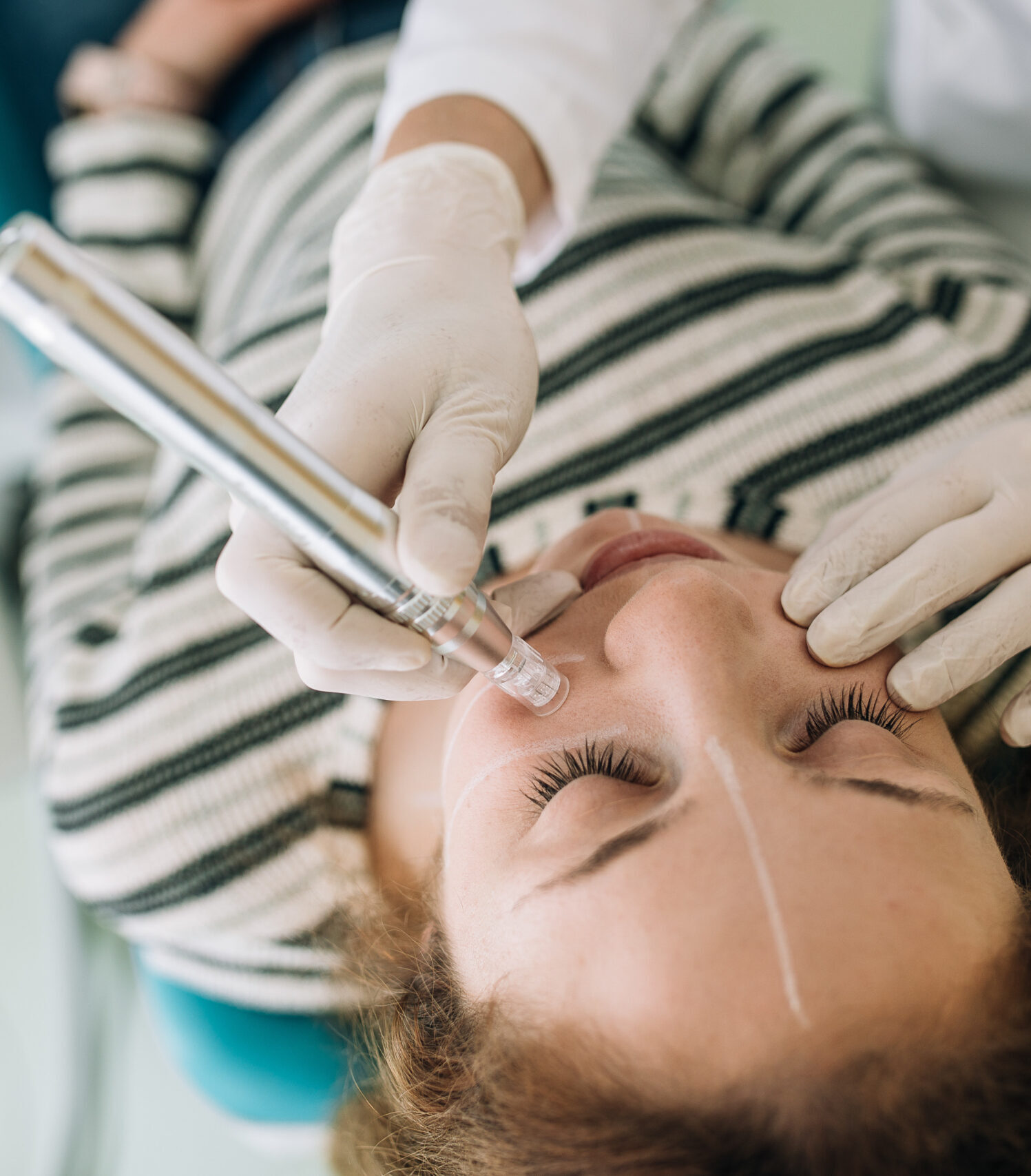 lepotna medicina lukan - microneedling